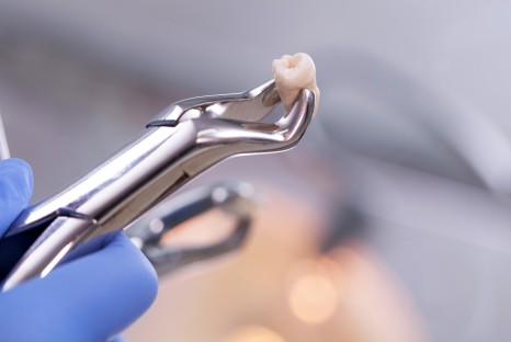Tooth Extractions