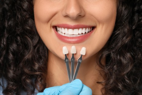 Veneers