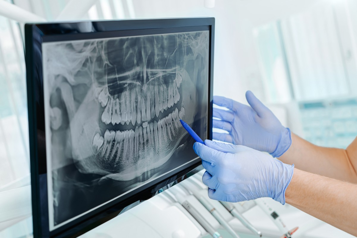 Dental X-Rays 